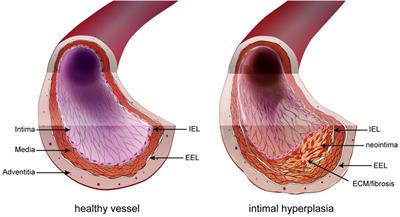 Clinical Use of Hydrogen Sulfide to Protect Against Intimal Hyperplasia